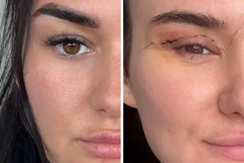 Side‑by‑side close‑ups of the same eye, showing a healthy eyelid on the left and a post‑surgical eyelid on the right with visible sutures and bruising.