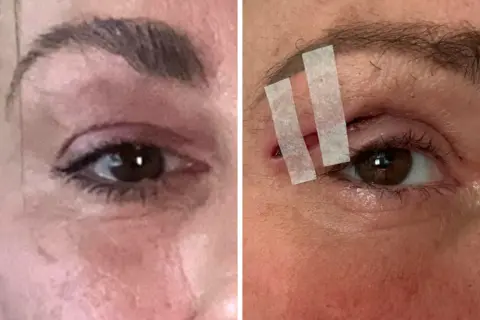 Side‑by‑side images showing the eye before treatment and the same eye afterwards, with medical tape applied over the healing upper eyelid.