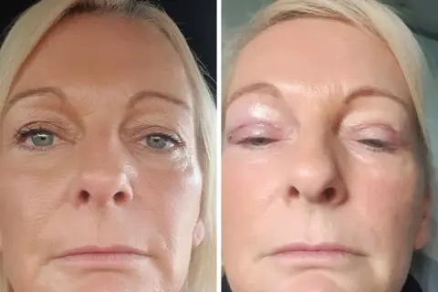 Side‑by‑side images showing Caryn before the eyelid surgery and afterwards. Second image shows a red scar on the upper eyelid as the area begins to heal.